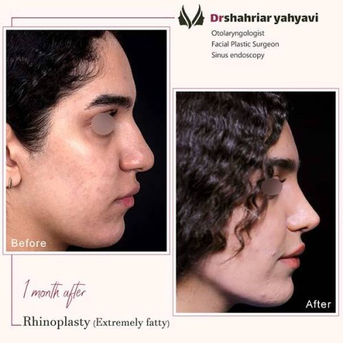 جراحی-بینی-918