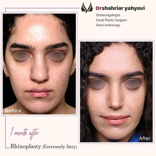 جراحی-بینی-919