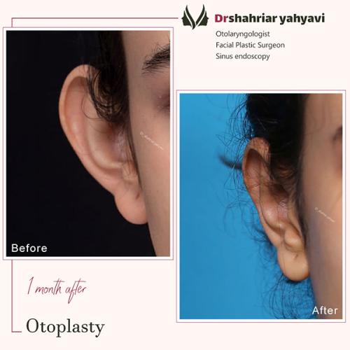 جراحی-گوش-23