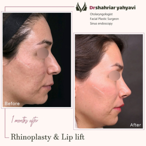 جراخی-بینی-874