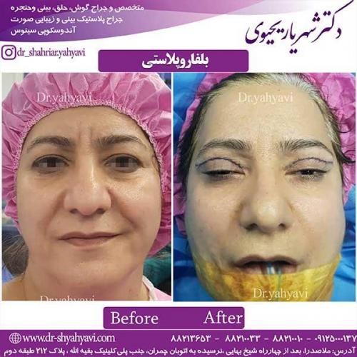 بلفاروپلاستی 1