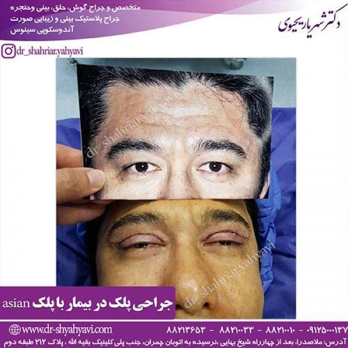 جراحی پلک 1