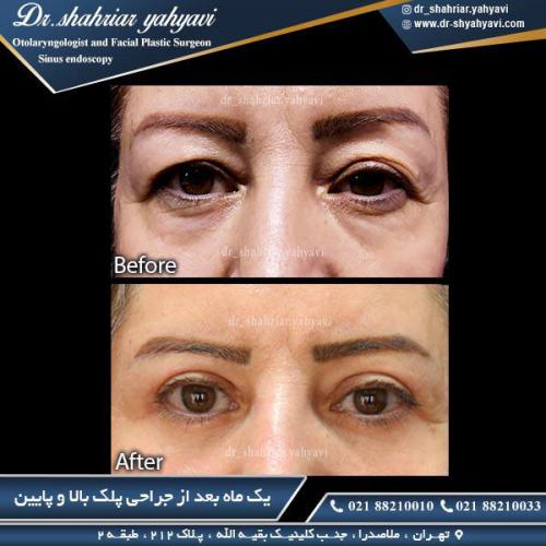 جراحی پلک 13