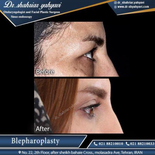 جراحی پلک 16