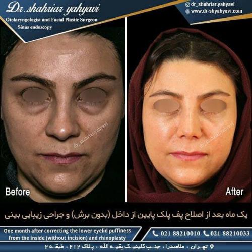 جراحی پلک 18