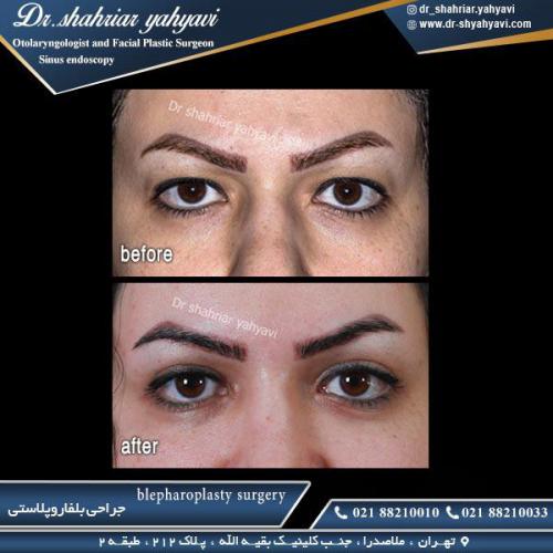 جراحی پلک 21