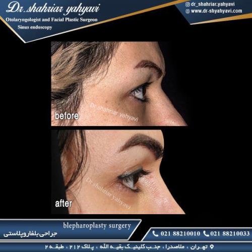 جراحی پلک 22