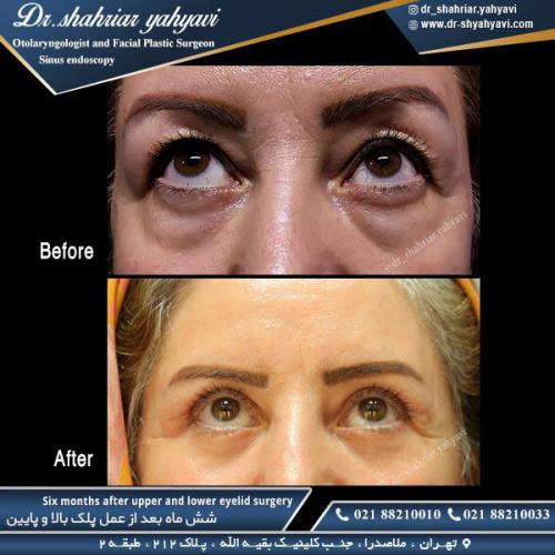 جراحی پلک 23