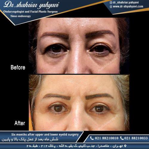 جراحی پلک 24