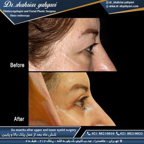 جراحی پلک 25