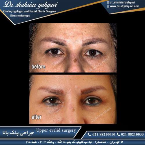 جراحی پلک 26