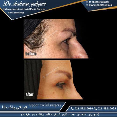 جراحی پلک 27