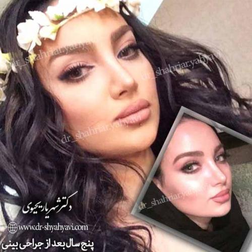 [جراحی زیبایی بینی 31
