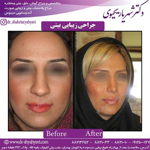 جراحی-بینی-100