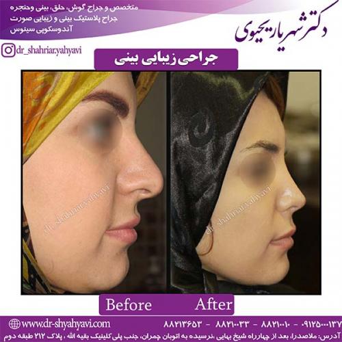 جراحی-بینی-102