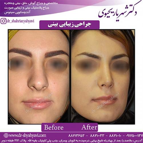 جراحی-بینی-103