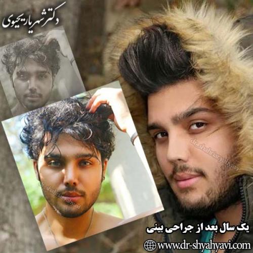 جراحی-بینی-104