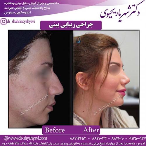 جراحی-بینی-105
