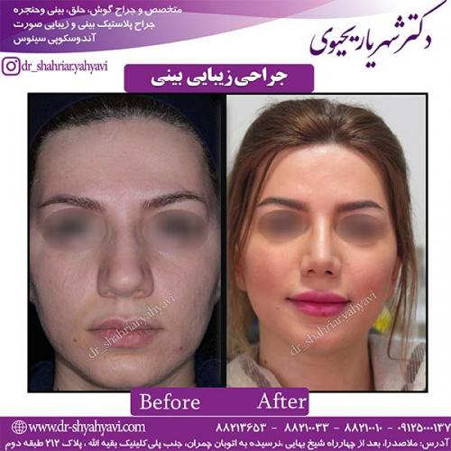 جراحی-بینی-106