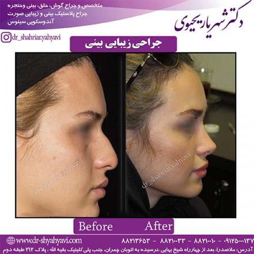 جراحی-بینی-109