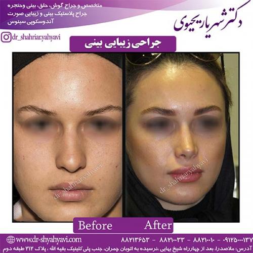 جراحی-بینی-110