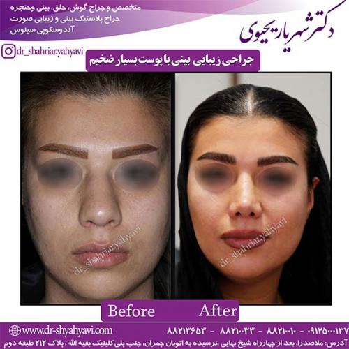 جراحی-بینی-111