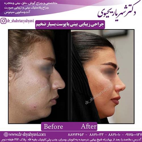 جراحی-بینی-112