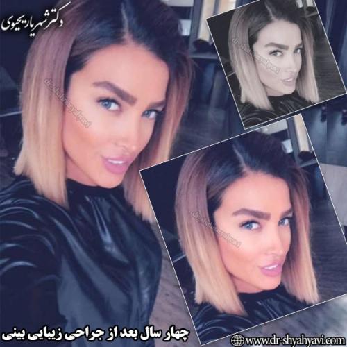 جراحی-بینی-113