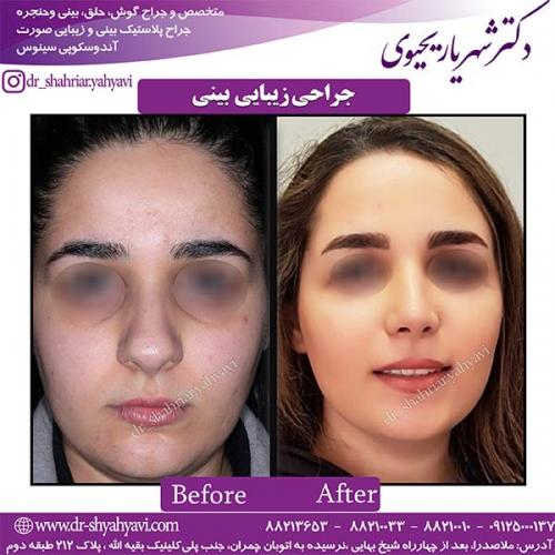 جراحی-بینی-114