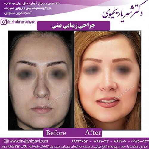 جراحی-بینی-117