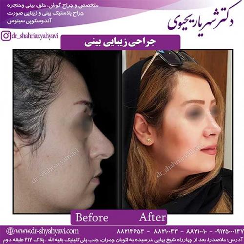جراحی-بینی-118