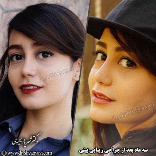 جراحی-بینی-119