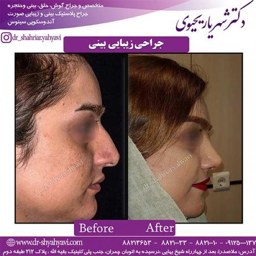 جراحی-بینی-121