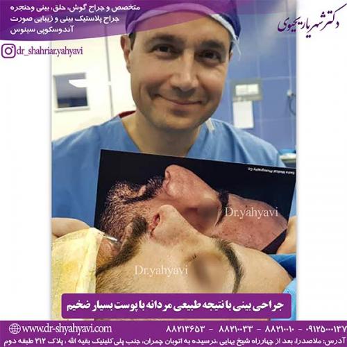 جراحی-بینی-122