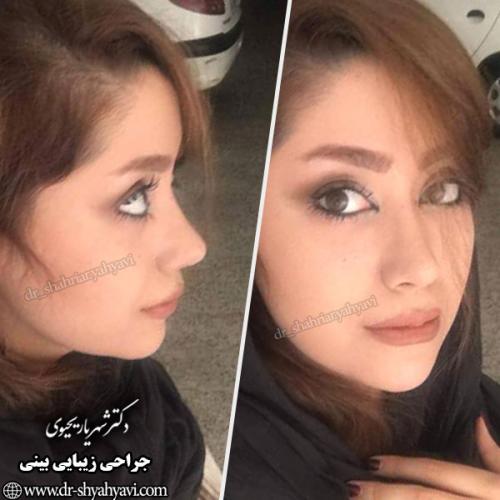 جراحی-بینی-123