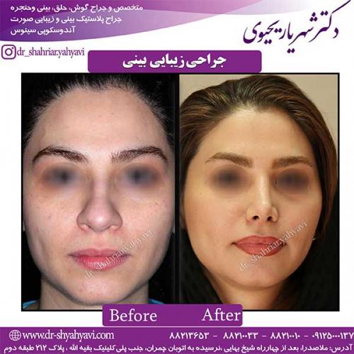 جراحی-بینی-124