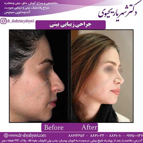 جراحی-بینی-125