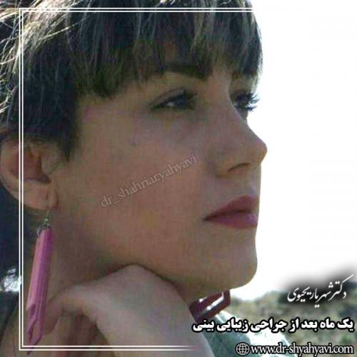 جراحی-بینی-126