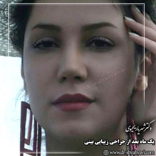 جراحی-بینی-127