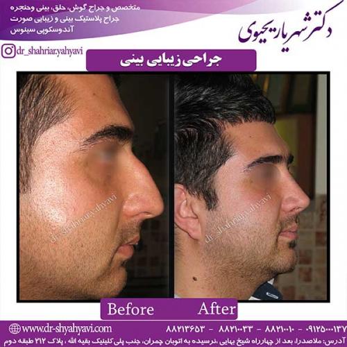 جراحی-بینی-128