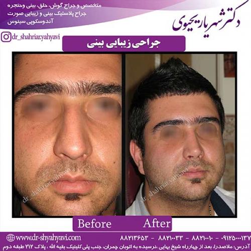 جراحی-بینی-129