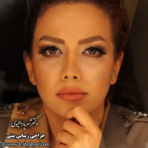 جراحی-بینی-130