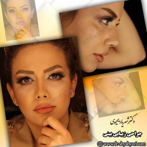 جراحی-بینی-131