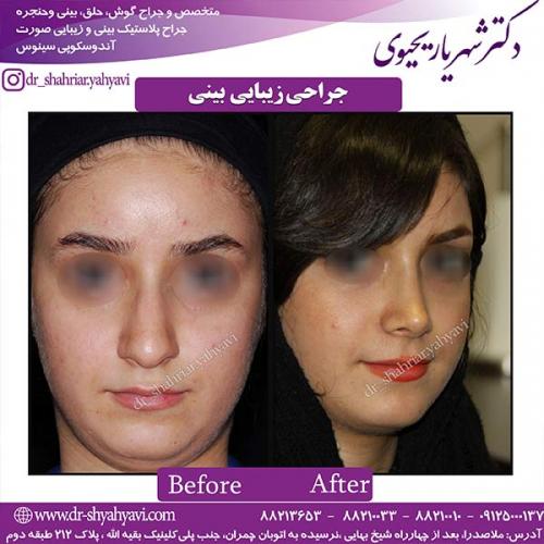 جراحی-بینی-132