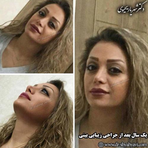 جراحی-بینی-133