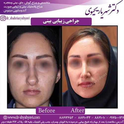 جراحی-بینی-134