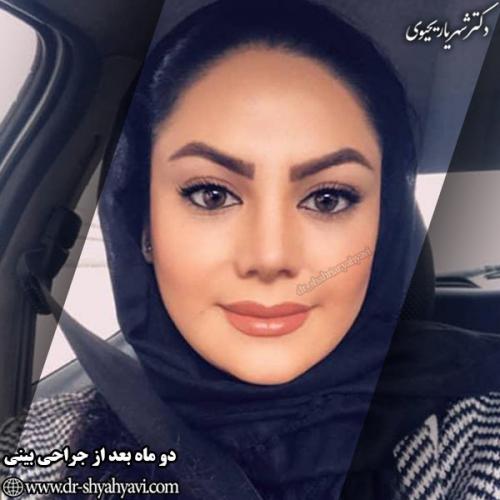 جراحی-بینی-135