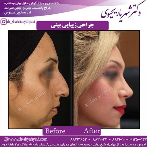 جراحی-بینی-136