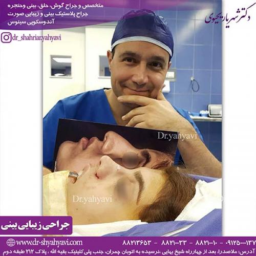 جراحی-بینی-137