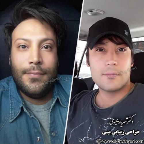 جراحی-بینی-138